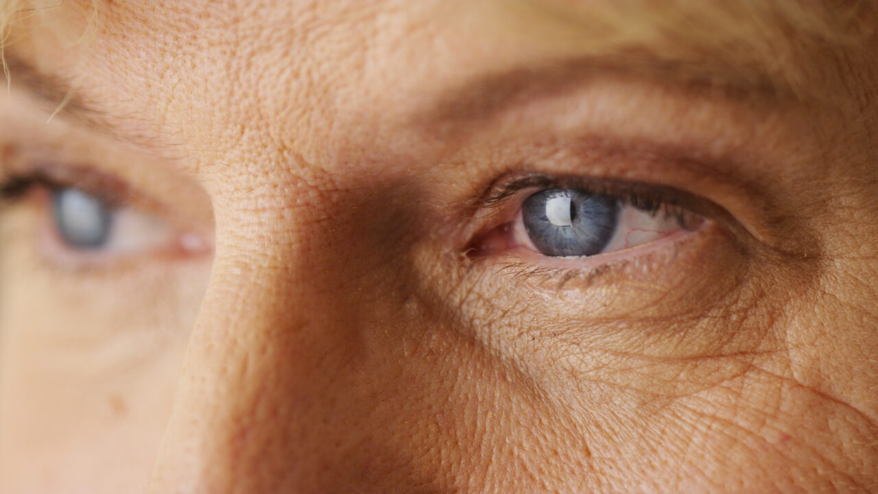 Plástica Ocular O Diferencial entre a Estética e a Saúde Funcional