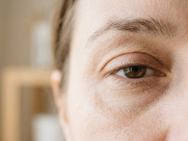 Sinais de que sua pálpebra caída pode ser ptose palpebral e não apenas cansaço